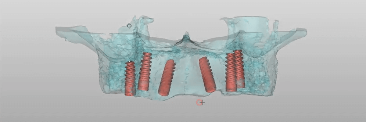 6 Implantate im Pberkiefer 3D Planung 1